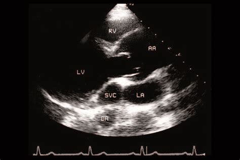 Echocardia .